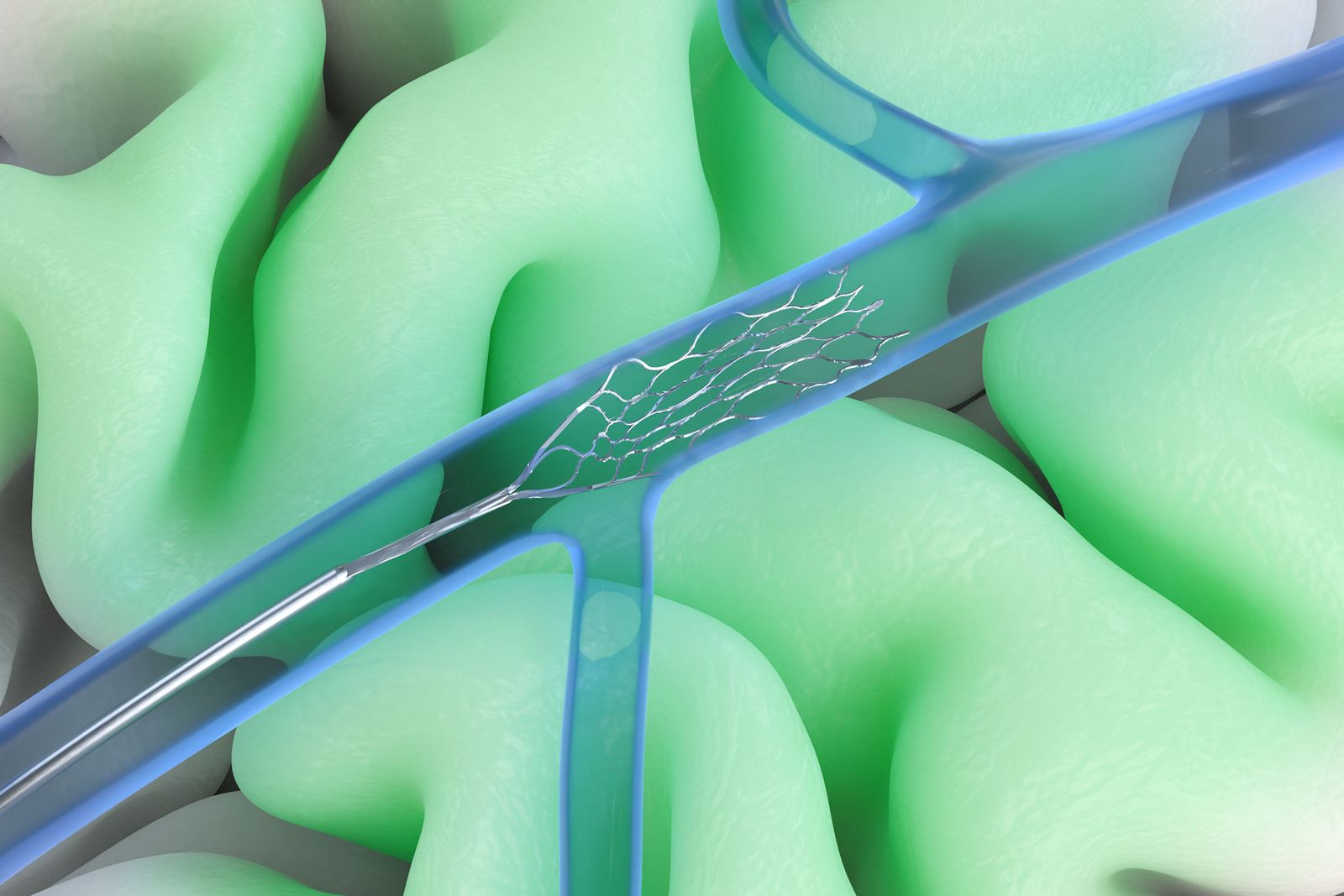 Synchron’s Brain-Computer Interface Now Has Nvidia’s AI